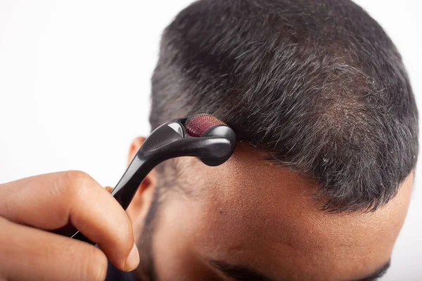 Man Using Derma Roller Bald Head Hairline Hair Growth Increase — стоковое фото
