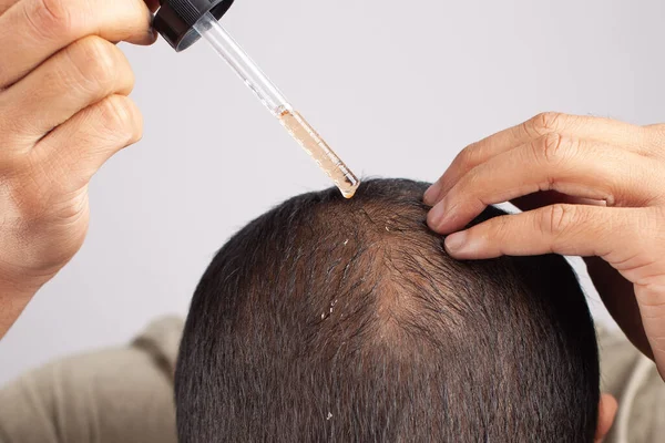 minoxidil oil, Caucasian male using hair growth oil by a dropper on scalp promote hair growth and reduce hair loss . Isolated in grey background.