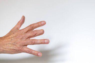 Elderly man right hand with amputated middle finger on white background