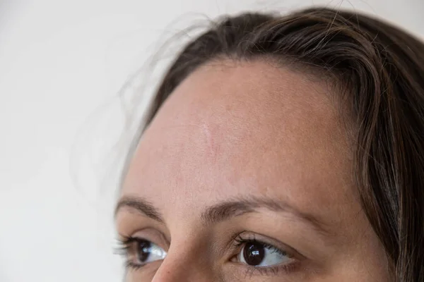 一个棕色头发的高加索女人额头上的刀疤白人背景 — 图库照片