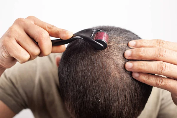 Man using dermaroller on bald patches for hair growth in white background.