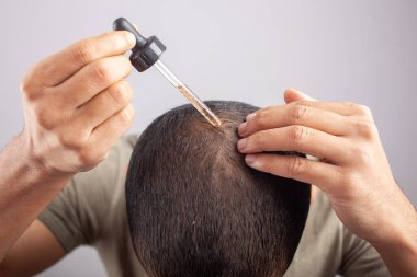 Minoxidil yağ, beyaz arka plan genç Kafkas erkek bir damlacık tarafından kafa derisine gerekli yağı sür.