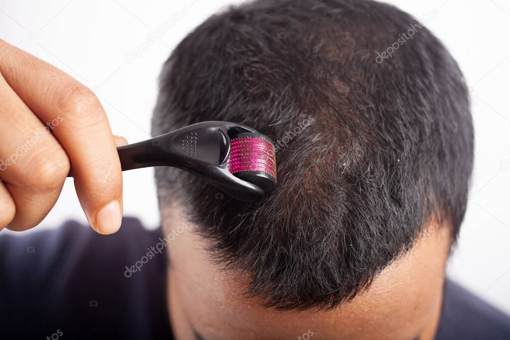 Microneedling, young man using derma roller on head for stimulating new hair growth and reduce hair loss or Androgenetic alopecia