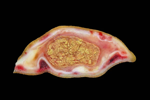 Närbild Sektion Cysta Tumör Isolerad Den Svarta Bakgrunden — Stockfoto