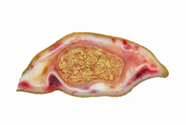 Närbild Sektion Cysta Tumör Isolerad Den Vita Bakgrunden — Stockfoto