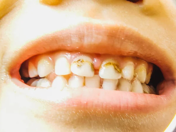 Primer Plano Boca Abierta Niño Con Algunos Dientes Podridos —  Fotos de Stock