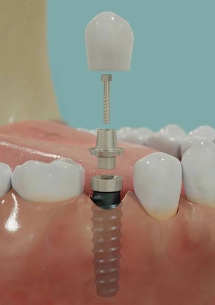 Вертикальный Вид Процесса Имплантации Одного Зуба — стоковое фото