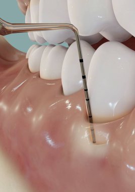 Periodontal inceleme ve anestezi illüstrasyonu