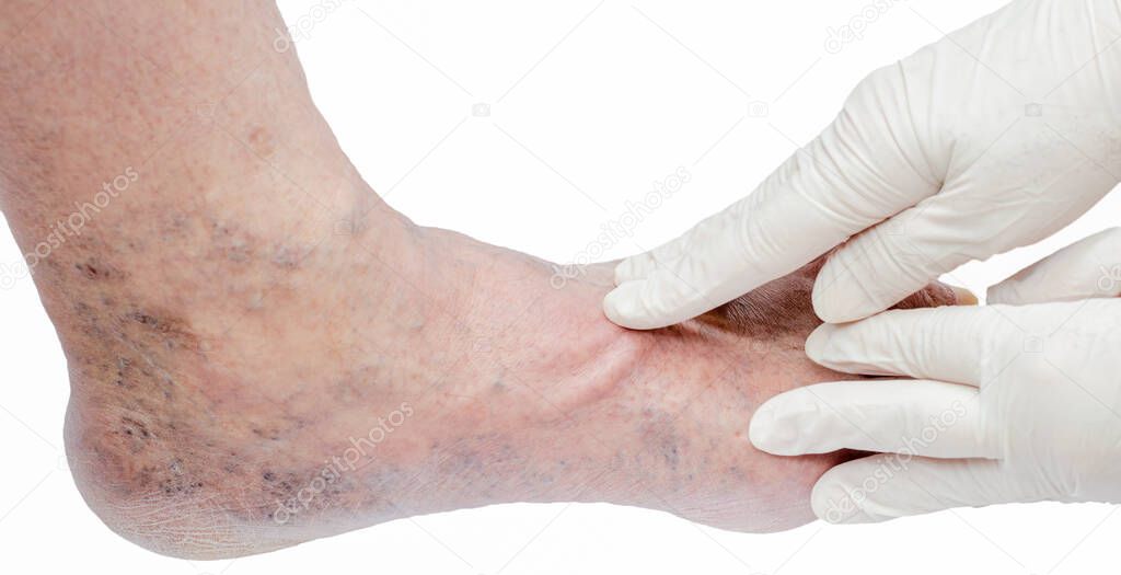 Doctor in white gloves holding man's foot and pointing to varicose veins, deep vein thrombosis, venous injuries on foot. Healthy varicose ulcer.