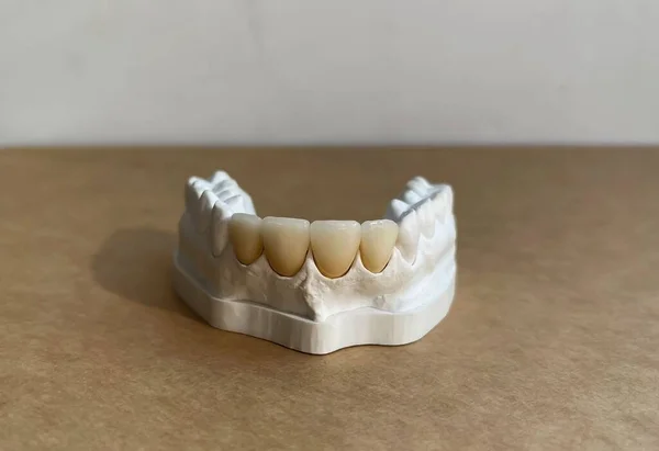 Крупный План Белого Зубного Протеза Коричневой Поверхности Копировальным Пространством — стоковое фото