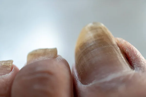 Een Close Van Lange Vuile Teennagel Van Het Linkerbeen — Stockfoto