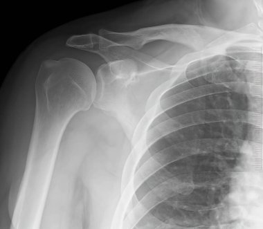 Röntgen omuz eklemleri. Akromiyoklaviküler kemikler. Tıbbi konsept. X-ray omuz eklemleri yapısı.