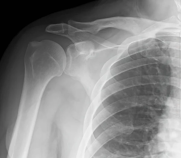 Die Schultergelenke Röntgen Akromioklavikuläre Knochen Medizinisches Konzept Struktur Der Schultergelenke — Stockfoto