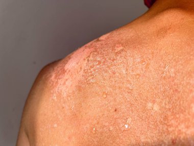 Peel back and shoulder skin from sunburn effect on young man body from sunbathing in summer
