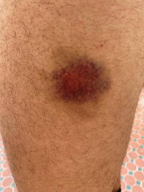 Sağlık hizmetine ihtiyacı olan bir adamın kalçasında iltihap ve kızarıklık var.