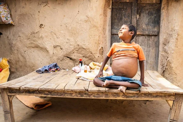 Distensión Abdominal Prominente Sudeste Delhi Hombre Indio Abdomen Distendido Puede — Foto de Stock