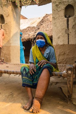 Filariasis, parazit benzeri yuvarlak solucanlar tarafından üretilen bulaşıcı bir tropikal hastalıktır..