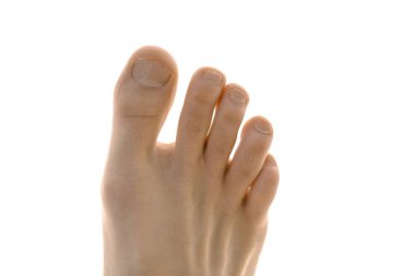 Ayak tırnakları kırık, beyaz arka planda izole bir adamın ayağı.