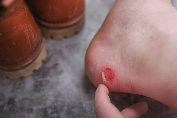 A rubbed blister on the heel of the foot caused by severe friction in shoes.