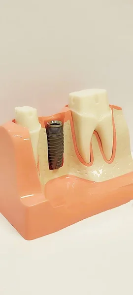 Plan Rapproché Vertical Des Prothèses Dentaires Procédé Pose Implant — Photo