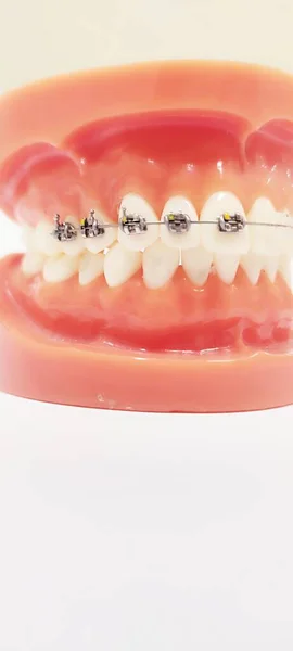 Vertical Closeup Shot Dental Prosthetics Brackets — Stock Photo, Image