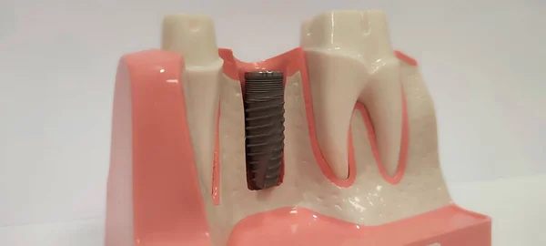 Primo Piano Strumenti Dentali Protesi Invisaligine Siringa Anestesia Silicone — Foto Stock