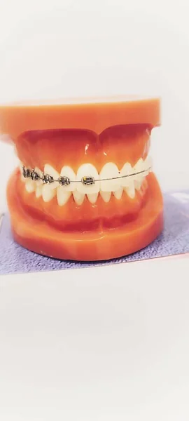 Vertikální Detailní Záběr Zubní Protézy Konzolami — Stock fotografie