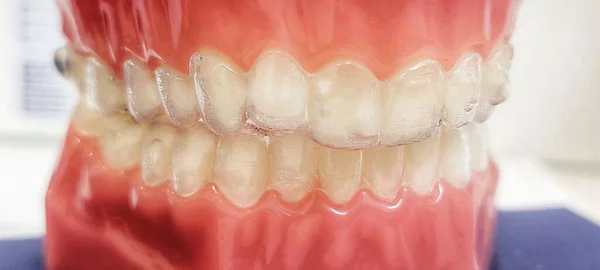 歯科用義肢の閉鎖ショット — ストック写真