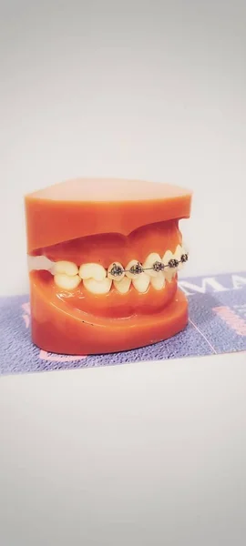 歯列矯正の垂直閉鎖ショットブラケット付き — ストック写真
