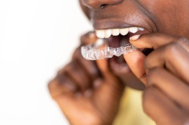 Genç bir kadın görünmez diş hizalayıcısı takıyor.