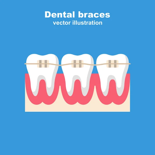 Apparecchi dentali. Denti con l'apparecchio. Livellamento dei denti — Vettoriale Stock