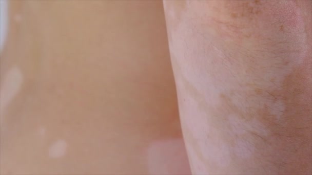 Pele Humana Com Vitiligo Close Imagens Alta Qualidade — Vídeo de Stock
