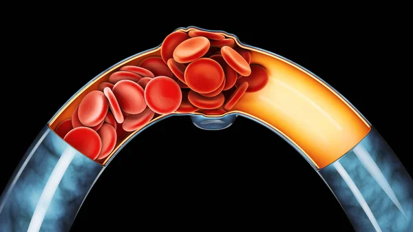 3 ‑ я фаза глубокого тромбоза или кровоточащих сгустков. Эмболия, обрезка пути включены — стоковое фото