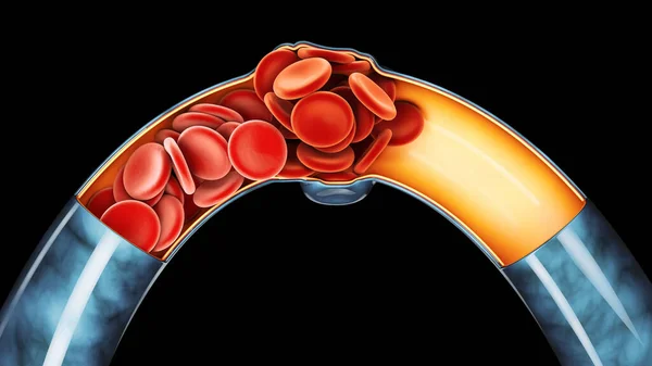 3D深静脉血栓形成或血块的说明。浮雕，剪裁路径包括 — 图库照片