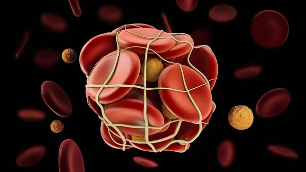3D-ілюстрація тромбозу глибокої вени або тромбів крові. Емболія, відсічний контур включено Стокова Картинка