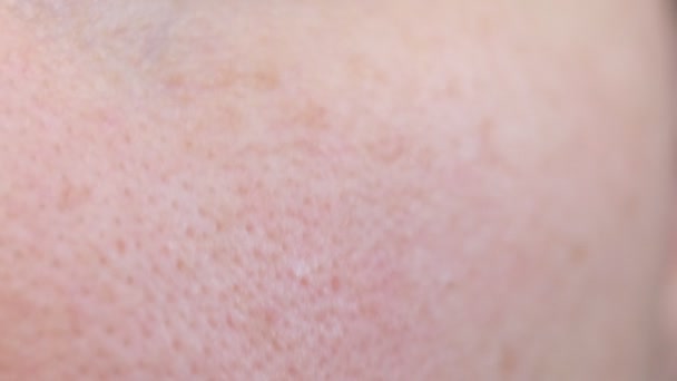 Yüzündeki gözenekler. Yüzünün yağlı derisi. Kadınların bir kısmı yakından çekilir. Kızarıklık, alerji, cilt sorunu. Genişletilmiş gözenekli deri dokusu. — Stok video