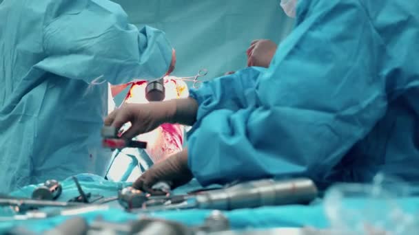 Patiënten ledemaat wordt geopereerd door een team van chirurgen — Stockvideo