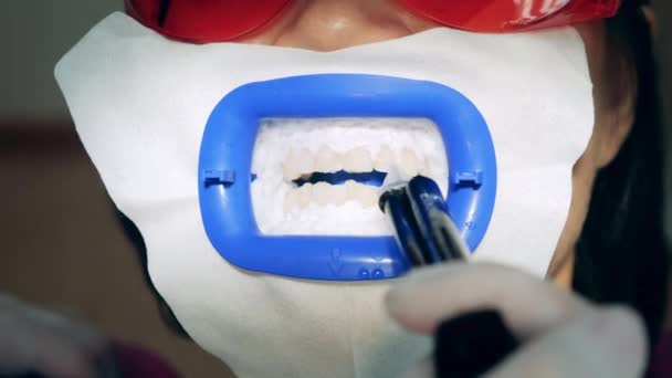 Procedura di candeggio dentale eseguita su un paziente — Video Stock