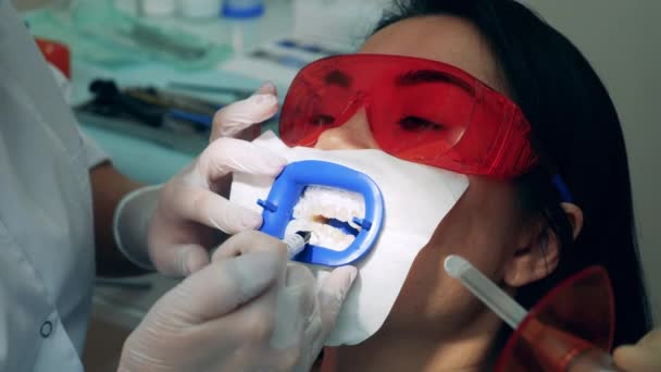 Paciente femenina está teniendo sus dientes blanqueados — Vídeo de stock