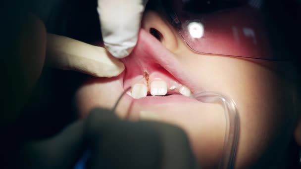 Primer plano de las encías de las mujeres que son arregladas por un dentista — Vídeo de stock