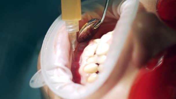 Detailní záběr anestetika injekčně do dásní pacientů — Stock video