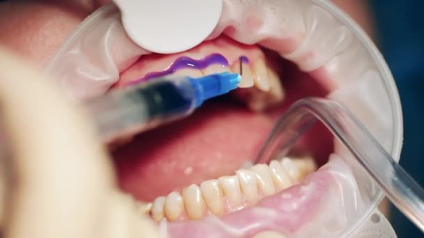 Zbliżenie leku stomatologicznego nakładanego na zęby pacjenta — Wideo stockowe