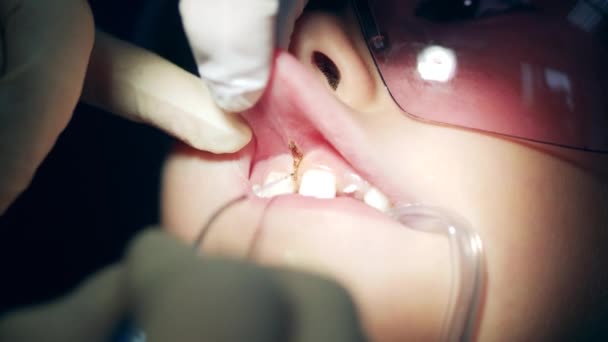 Close-up de pacientes gengivas sendo tratados por um dentista — Vídeo de Stock