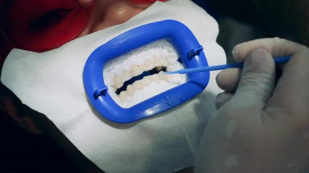 患者の歯に漂白ペーストが適用されています — ストック動画