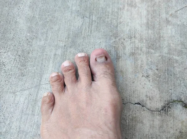 a disfigured big toe nail due to an injury.
