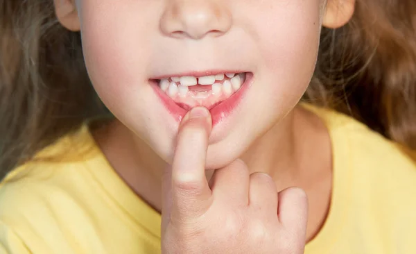 Das Süße Kleine Mädchen Hat Die Ersten Milchzähne Verloren Mundhygiene — Stockfoto