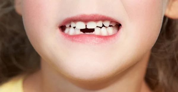 Słodkie Dziecko Straciło Pierwsze Dolne Zęby Mleczne Higiena Jamy Ustnej — Zdjęcie stockowe