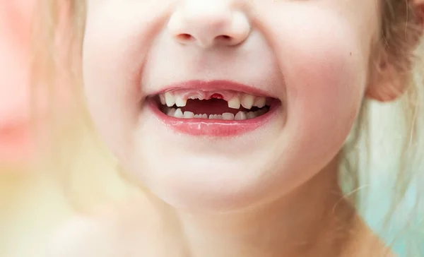 A little girl lost her baby milk tooth. Lost temporary tooth. The concept of oral hygiene in children. Close-up of the oral cavity