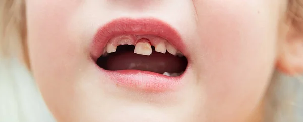 Una Niña Perdió Diente Leche Perdió Diente Temporal Concepto Higiene — Foto de Stock