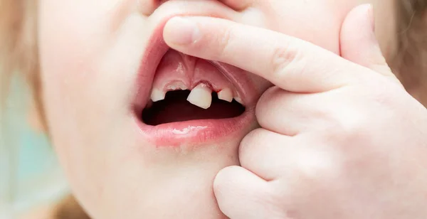 Uma Menina Perdeu Dente Leite Dente Temporário Perdido Conceito Higiene — Fotografia de Stock
